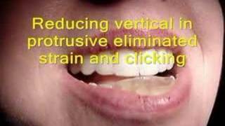 TMJ click with NTI and its resolution [upl. by Elise399]