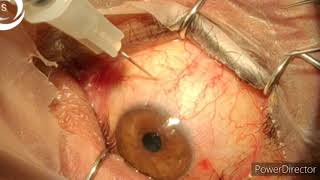 800 how to inject intravitreal to avoid endophthalmitis [upl. by Eldnek]