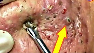 cystic acne treatment big acne removal compilation [upl. by Loomis]