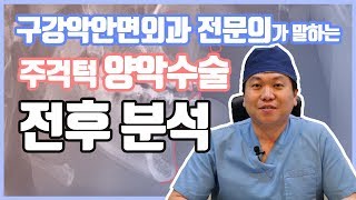 구강악안면외과 전문의s 주걱턱 양악수술 전후로 분석하기 ㅣ 줌구강악안면외과 [upl. by Lucita]