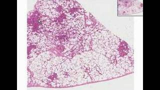 Histopathology LungBronchopneumonia [upl. by Acihsay]