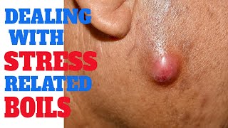 Skin boils and stress  Does stress cause skin problems  Hidradenitis Suppurativa  Causes of boils [upl. by Leinad]