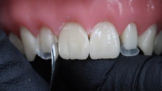 Peg Laterals Restorations with Rhodri Thomas BDS [upl. by Pammy521]