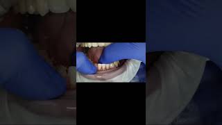 Maryland HIPC bridge for lower anterior teeth replacement shorts [upl. by Maryanna344]