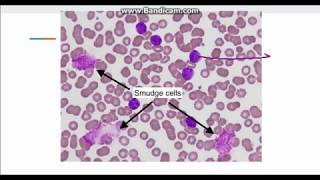 Chronic Lymphocytic Leukemia CLL [upl. by Amian]