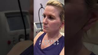 Natural Results  Mini Facelift with Neck Lift  Before amp After [upl. by Noyart9]