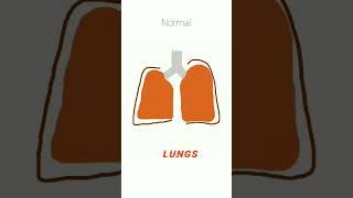 Emphysema vs Empyema medical cardiorespiratory physiotherapy [upl. by Drucilla]