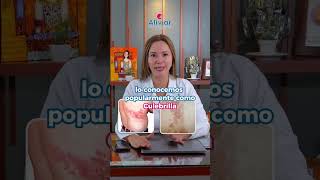 Dolor por Herpes Zoster quotCulebrillaquot [upl. by Adnohr]