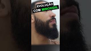 evolução 9 meses MINOXIDIL KIRKLAND minoxidil barba thedicas [upl. by Hurlee668]