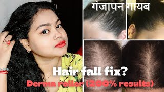 Derma roller hair growth 200 fast result नए बाल उगने का रामबाण तरीका The End Game [upl. by Afrikah865]