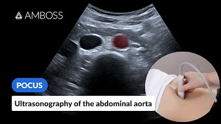 Point of Care Ultrasound of the Abdominal Aorta  AMBOSS Video [upl. by Sirod]