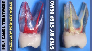 Pulp Canal Treatment 🟡 Maxillary Primary Molar 🔵 step by step demonstration [upl. by Jung]