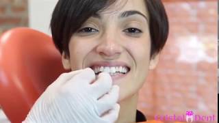 Applicazione Faccette Dentali  Torino [upl. by Rihana]