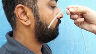 NASOGASTRIC INTUBATION RYLES TUBE FEEDING TUBE INSERTION [upl. by Ariadne]