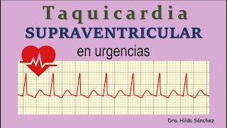 Taquicardia SUPRAVENTRICULAR en urgencias [upl. by Meagher]