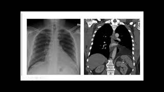 Chest XRay breakdown assessing a film with pleural plaques [upl. by Thatch]