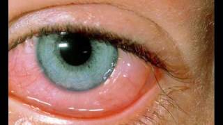 Conjuntivitis Alergica  ESPANOL [upl. by Krishna]