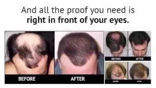 Restore Your Hair Loss Naturally  Secret Hair Restoration Formula [upl. by Anitel]