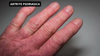 ARTRITE PSORIASICA [upl. by Mame]