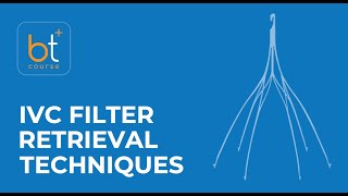 Case Discussion IVC Filter Retrieval Techniques w Dr Noor Ahmad [upl. by Annehsat184]