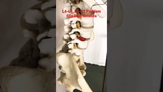 L⁴L⁵L⁵S¹ Disc problem discpain backpain shorts trending backpaintreatment [upl. by Einrae]