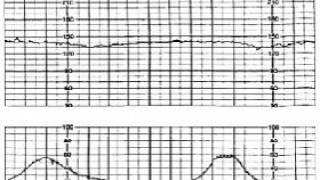 16 Intrapartum Fetal Monitoring [upl. by Becki]