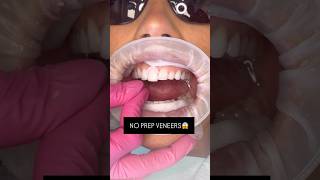 NO PREP VENEERS 🤯🦷Smile Texas smiles veneers smilemakeover smiledesign teeth dentalveneers [upl. by Ahsenyl]