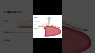 What is biopsy  doctors knowledge [upl. by Thay409]