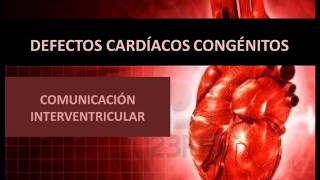 Defectos cardíacos congénitos  Comunicación interventricular [upl. by Nymzaj]