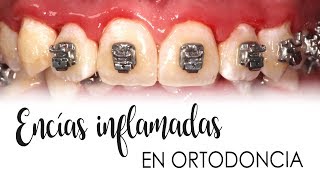 ENCÍAS INFLAMADAS CON ORTODONCIA  CAUSAS Y TRATAMIENTO [upl. by Shurlocke]