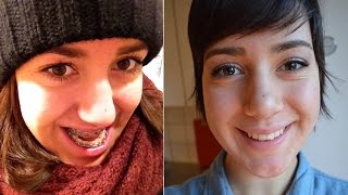 Double Jaw Surgery Before During and After Pictures amp Videos [upl. by Htrahddis84]