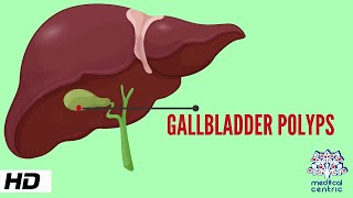 Gallbladder Polyp Causes Signs and Symptoms Diagnosis and Treatment [upl. by Ellehcar]