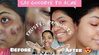 My Acne Transformation Products That Actually Work [upl. by Tawney430]