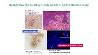 3 Step Algorithm for Acral Melanocytic Lesions  Dr Toshiaki Saida [upl. by Ylrak248]