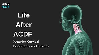 Life After ACDF Anterior Cervical Discectomy and Fusion [upl. by Eednak]