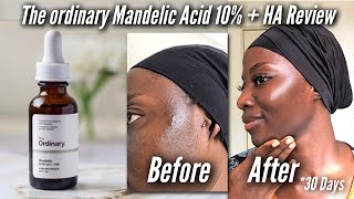 THE ORDINARY MANDELIC ACID 10  HA INDEPTH REVIEW [upl. by Pearlman]