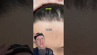 How I Got An INCREDIBLE Hairline Lowering Result [upl. by Redyr]