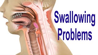 Swallowing Problems or Dysphagia Top 4 Possible Causes Including Cricopharyngeal Dysfunction CPD [upl. by Aehtna]