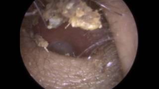 206 Ear Wax CRUMBLE Removed using Ear Hook and Jobson Horne  Mr Neel Raithatha THC [upl. by Giguere]