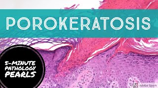 Porokeratosis 5Minute Pathology Pearls [upl. by Aihsaei]