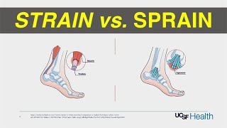 Strain vs Sprain Treatment [upl. by Esau]