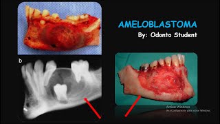 Ameloblastoma Etiología Características  Clínicas Radiográficas Histológicas y Tratamiento [upl. by Carline]