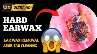 A hard mass blocks the ear canal  ear wax removal  ASMR  satisfying  The cleansing realm [upl. by Nihcas]