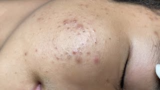 ACNE TREATMENT VU QUYNH MI Acne On Teens Chin 2024 [upl. by Sixel285]