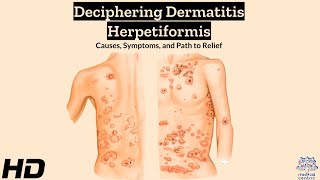 Dermatitis Herpetiformis Explained Symptoms Triggers and Relief [upl. by Taddeo]