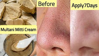 How To Remove Open Pores Blackheads At Home  Permanent Blackheads Removal Pack 100  Natural [upl. by Map]