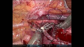 MId tracheal resection at innominate artery robotically on VV ECMO [upl. by Asiole]