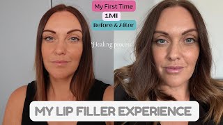 My Lip Filler Experience  What To Expect When Healing  05ml or 1ml [upl. by Aivyls]