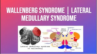 Wallenberg Syndrome  Lateral Medullary Syndrome  PhysiotherapyKnowledge [upl. by Dorris]