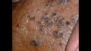 Shocking Cystic Blackheads amp Whiteheads Extraction Revealed  new blackheads this week 7 [upl. by Zoltai]